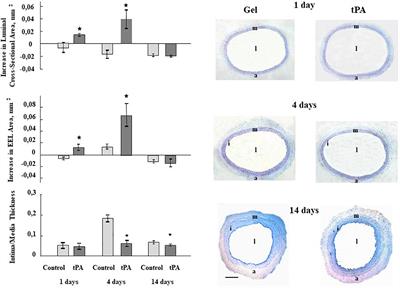 Oligonucleotide Microarrays Identified Potential Regulatory Genes Related to Early Outward Arterial Remodeling Induced by Tissue Plasminogen Activator